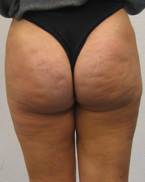 Butt Cellulite 7